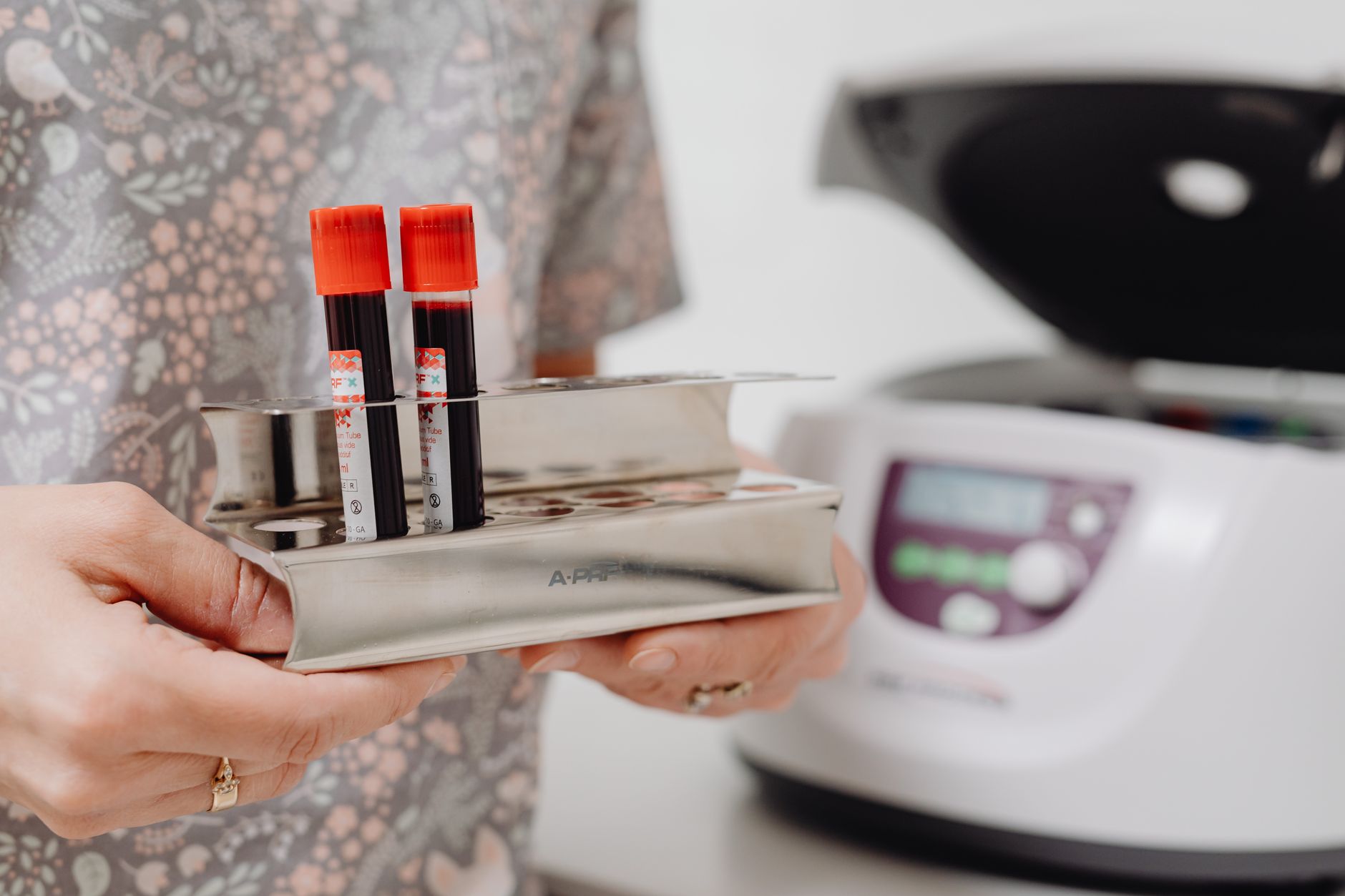 Analiza HbA1c: Cum indică hemoglobina glicată riscul de prediabet și diabet