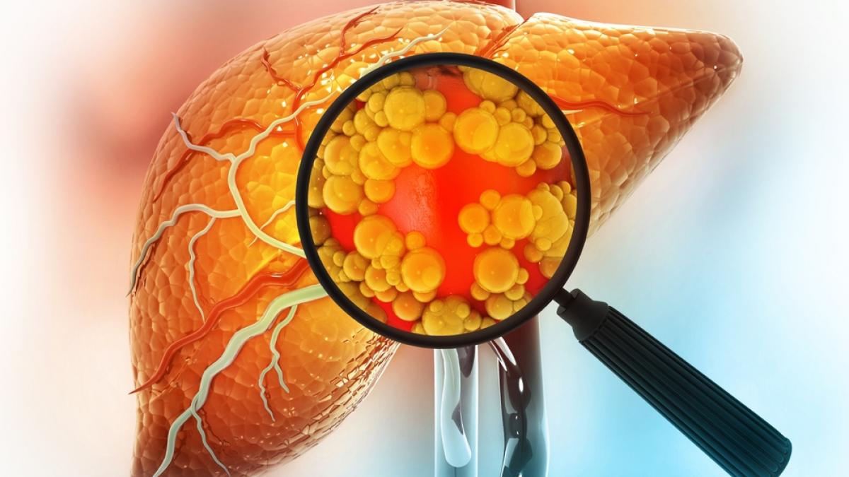 Steatoza hepatică, cunoscută sub numele de ficat gras: cauze, simptome și metode de tratament