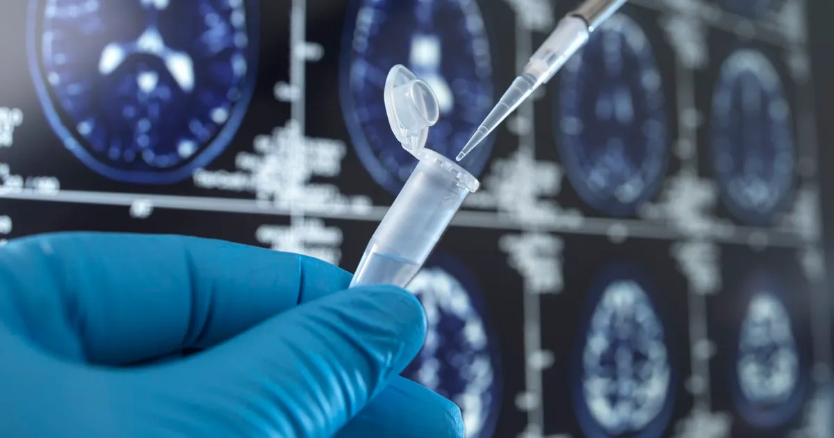 Impactul insomniei asupra sănătății cognitive: un model indică jumătate de milion de cazuri de demență evitabile