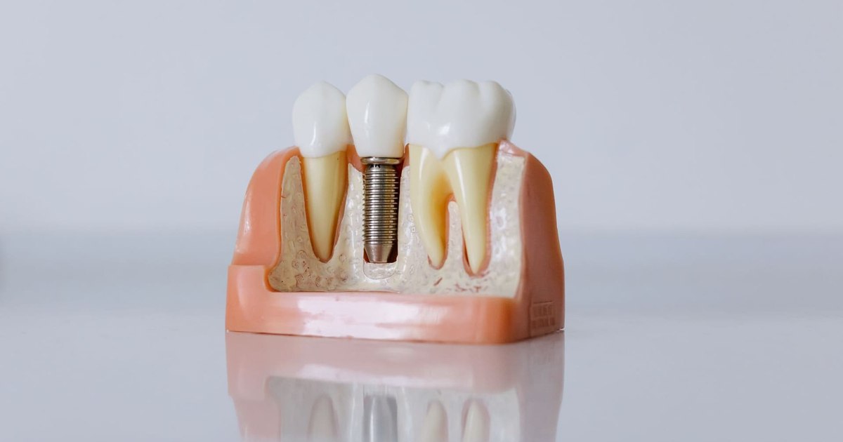 Condiții stricte pentru implanturile dentare cu încărcare imediată: ce trebuie să știe pacienții