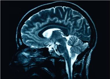 Noua descoperire științifică: Leziunile cerebrale provocate de Alzheimer ar putea fi inversate