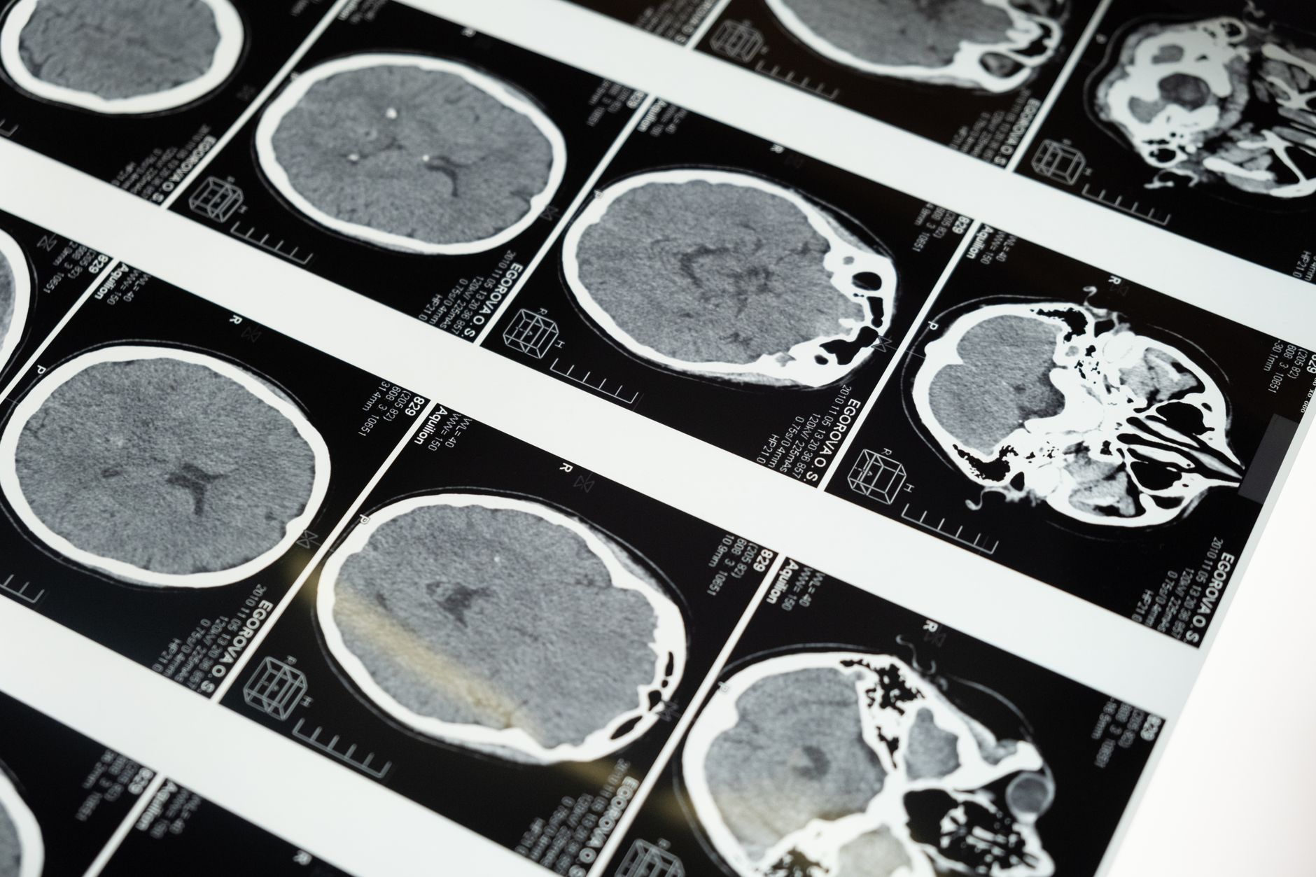Legătura dintre radiațiile ionizante și boala Alzheimer: ce spun noile cercetări ale specialiștilor din SUA