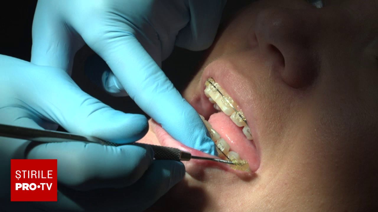 Aparate dentare false pentru estetică: noua modă de pe TikTok care pune în pericol sănătatea orală