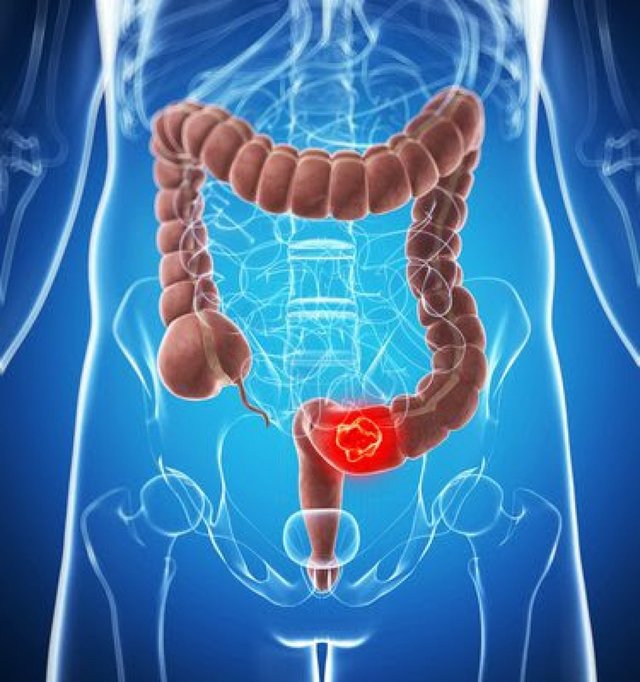 Studii medicale: Apendicectomia ar putea fi asociată cu un risc mai scăzut de cancer colorectal