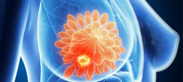 Sistem de inteligență artificială care reduce numărul cancerelor mamare omise de medici