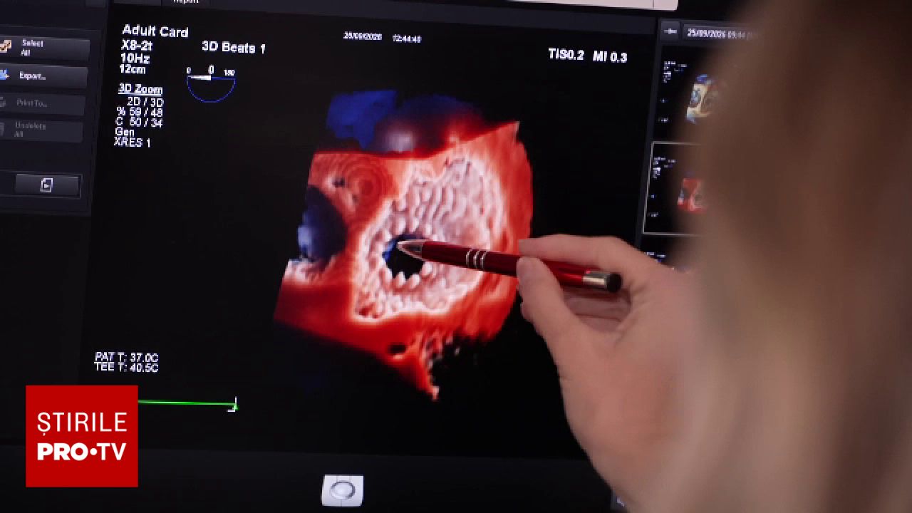 Intervenție medicală de excepție la Spitalul Floreasca: valvă biologică implantată fără oprirea inimii