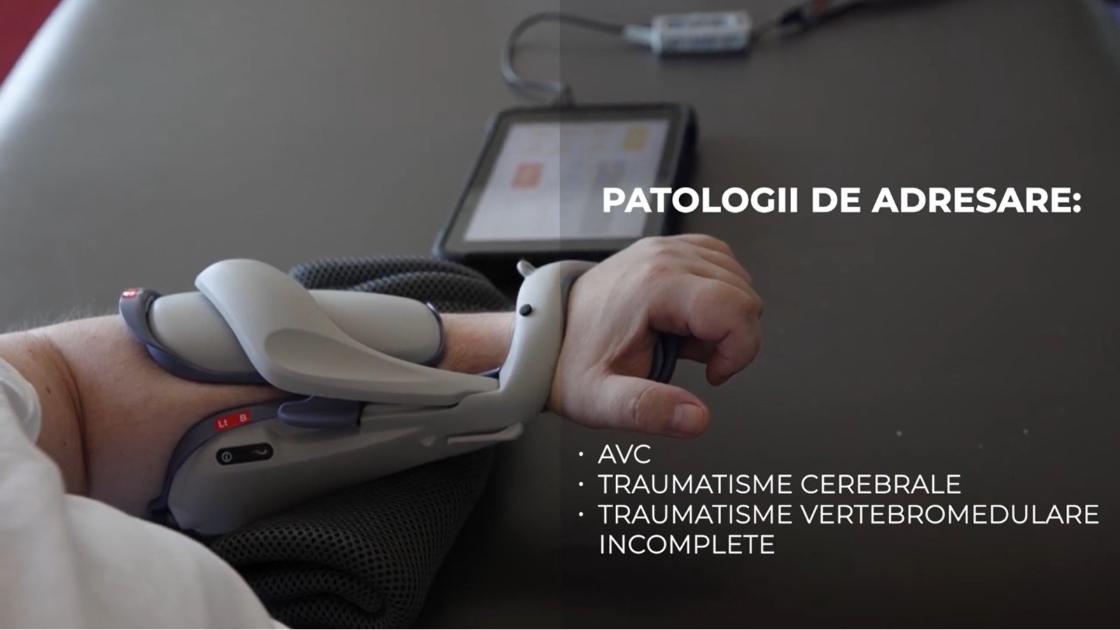 Tehnologie inovatoare pentru recuperarea mâinii după un AVC: cum funcționează esteza Bioness