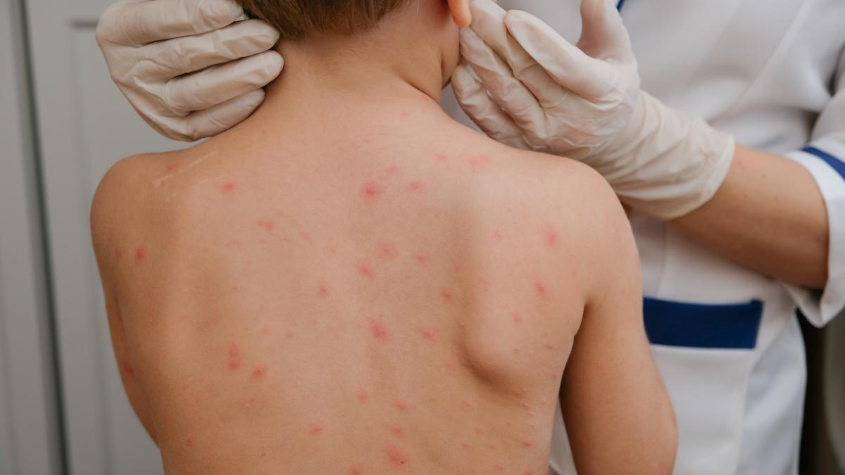 Epidemie de rujeolă în SUA: Patru decese noi și tensiuni politice între Pennsylvania și Washington