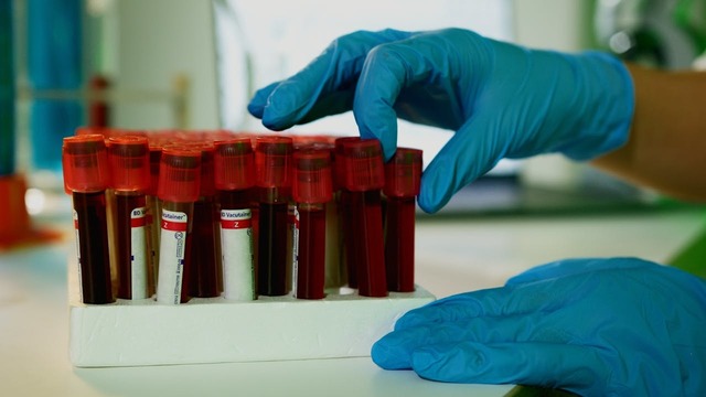 România are una dintre cele mai mari proporții de diagnostice HIV tardive din Europa