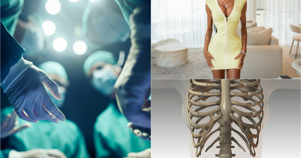 Avertisment medical privind o nouă metodă de remodelare a corpului: fracturarea coastelor pentru o talie mai mică